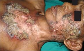 It usually affects the face, or the buttocks and trunk. View Image