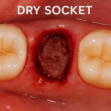 Image result for Dry Socket