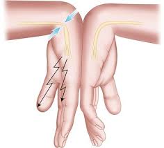 Carpal tunnel syndrome is often misdiagnosed as arthritis of the carpometacarpal joint of the thumb, cervical radiculopathy, or diabetic polyneuropathy. Carpal Tunnel Syndrome Springerlink