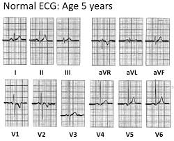 Paediatric Ecg Interpretation Litfl Medical Blog Ecg