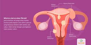 Nyeri punggung bawah adalah tanda umum fibroid rahim disertai nyeri panggul. Mioma Uteri Tanda Dan Gejala Penyebab Cara Mengobati Cara Mencegah