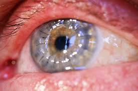 Test ülserin bakteri, mantar veya virüs içerip içermediğini gösterecektir. Transplantasi Kornea Patofisiologi Diagnosis Penatalaksanaan Alomedika