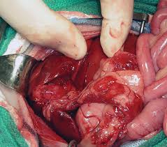 Maybe you would like to learn more about one of these? Open Laparoscopic Liver Biopsy Clinician S Brief