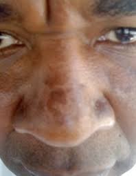 Check spelling or type a new query. Sun Burn