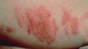 Check if you have heat rash. Rash 101 In Adults When To Seek Medical Treatment