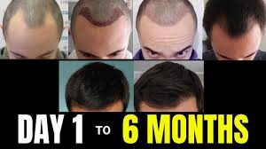 You are describing accurately how hair grows after a hair transplant. From Day 1 To 6 Months Hair Transplant Update Comparison Video Youtube