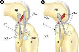 The lcl is located on the outer side of the knee. A Proposal For A New Classification Of The Fibular Lateral Collateral Ligament Based On Morphological Variations Sciencedirect