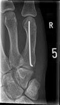 Agaplesion Dkh Mittelhandbruch