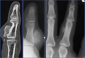 Any bone can be affected, although bone cancer most often develops in the long bones of the legs or upper arms. The Radiology Assistant Sclerotic Tumors