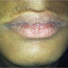 The key here is understanding that healthy hair = longer hair, so making little changes that support your hair and scalp (see: Excessive Hair Growth Over Upper Lip And Chin Download Scientific Diagram