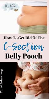How To Eliminate Your Mummy Tummy After A C Section Baby Belly Workout C Section Belly Postpartum Belly Workout