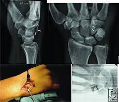 Image result for Hamate Bone