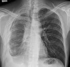 It is usually symptomatic and is commonly associated with a malignant cause.20 the diagnosis of a malignant pleural effusion is discussed in the guideline on the investigation of a unilateral pleural effusion. Clinical Vignette 27 Miphidic
