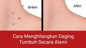 June 30 at 8:00 am ·. Cara Menghilangkan Daging Tumbuh Youtube