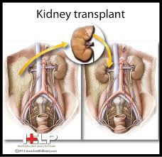 Kidney Transplant Kidney Transplant Kidney Donation Kidney Disease