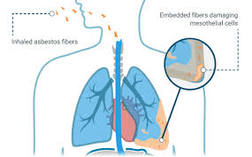 Mesothelioma may not cause any symptoms until it is more advanced, and the tumor has grown enough to affect the tissues and organs near it. Mesothelioma What Is Malignant Mesothelioma Cancer