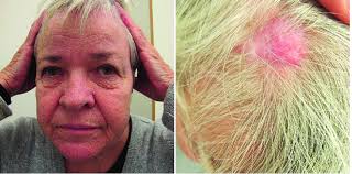 CYLD cutaneous syndrome. Written permission was given to publish this...