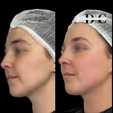 Mesoterapia Pink Glow