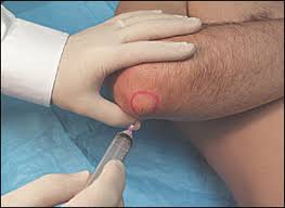Image result for Epicondyle Injection
