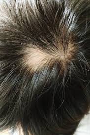 The two most important differential diagnoses in children presenting with patchy nonscarring hair loss are: Alopecia Areata In Children Reasons Signs Treatment