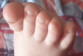 Image result for Clubbing nails feet