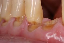 Image result for Tooth Abrasion