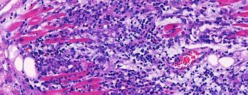 Chest pain may occur, in a variety of typical and atypical presentations. Fulminante Nekrotisierende Eosinophile Myokarditis Nach Akne Therapie Mit Minocyclin Swiss Medical Forum