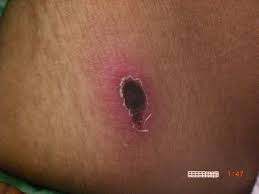 (17) to test if cerium neutralized this erythroid inhibitor, we applied cerium or silver nitrate to the eschar of a mouse model of thermal injury. Eschar Vs Scab What Is An Eschar
