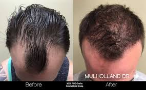 Hair transplant surgery for men may differ in how hair follicles are extracted from the donor site. Toronto Fue Follicular Unit Extraction Hair Transplant