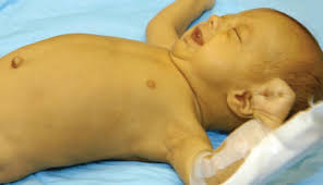 JAUNDICE IN NEONATAL | Chandigarh ...