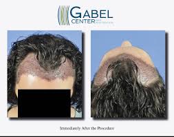 Watch A Patients Real Time Growth After 3439 Grafts Gabel