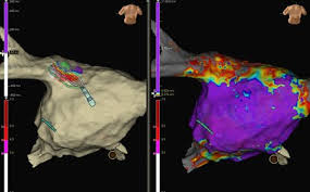 ¤ élimination rénale & longue t ½ ➡ s'accumule chez pa ¤ sx intoxication: Chr De La Citadelle Premiere Medicale En Belgique Ablation D Une Fibrillation Auriculaire Facilitee Par Une Nouvelle T