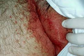 Sep 03, 2019 · some people find relief with a vinegar treatment for intertrigo. Intertrigo