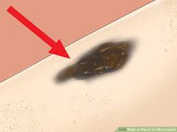 How To Check For Skin Cancer 9 Steps With Pictures Wikihow