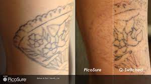 Picosure Vs Black Ink Diy Tattoo Tattoo Removal Laser Tattoo