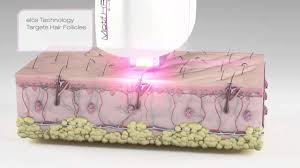 During each subsequent session, the system removes the hair that. Elos Hair Removal Treatment Clip Motif Mode Youtube