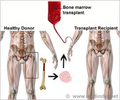 Check spelling or type a new query. Noninvasive Method To Detect Bone Marrow Cancer Proposed