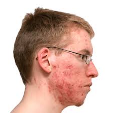 Image result for Seborrheic Dermatitis