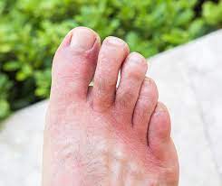Contact Dermatitis My Footdr