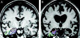 Because it is able to detect very small nodules in the lung, chest ct is especially effective computed tomography, more commonly known as a ct or cat scan, is a diagnostic medical imaging test. Alzheimer S Disease Diagnosis Evaluation And Treatment