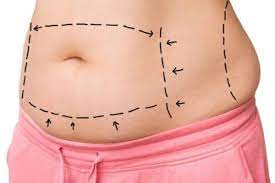 A list of countries by health insurance coverage. Is Abdominoplasty Better Or Paniclectomy Amitis Health Tourism Company