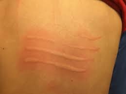 Image result for Dermatographism