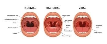 Image result for Uvulitis