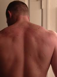 Oleh sebab itu, penyakit kulit tidak menular ini juga memerlukan. Jerawat Badan Ini Tip Terbaik Untuk Mencegahnya Glam Lelaki