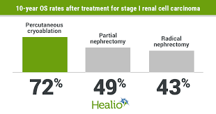 It is harder to discover the condition just by searching or feeling for development. Percutaneous Cryoablation Prolongs Survival In Early Stage Renal Cell Carcinoma