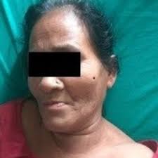 Characteristics of 25 cases of S. aureus-induced Lemierre-like syndrome.