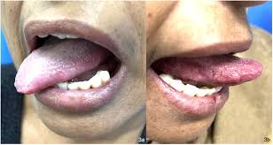 Image result for syphilis ulcer