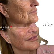 Just absolutely beautiful results yet again with Bellafill! ✨ Bellafill is  perfect for filling in deep lines and wrinkles and also great for areas  like the cheeks to create a beautiful lift!