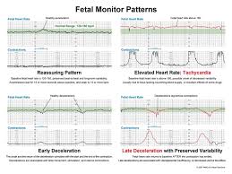 Image result for Late Deceleration
