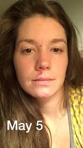 What is the best product for healing and scarring above lip after stitches  removal?